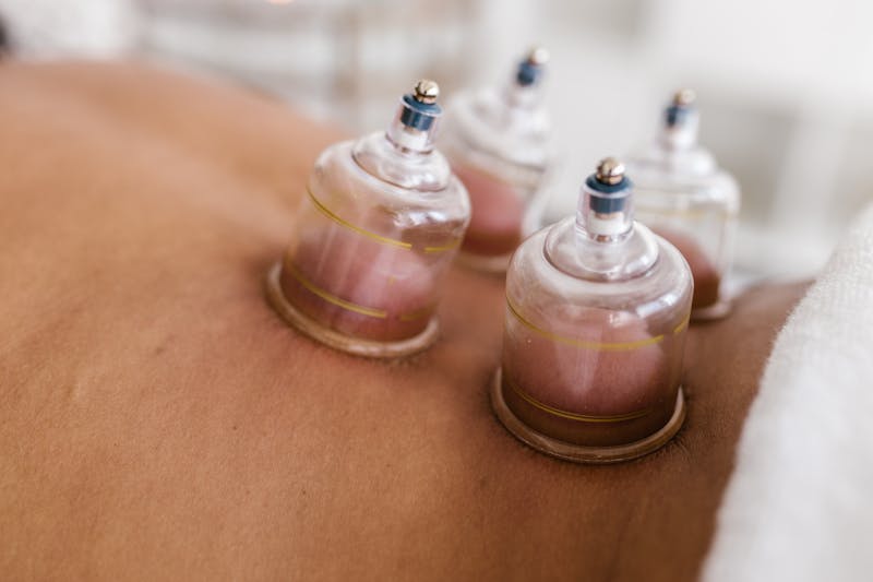 Close-up of cupping therapy cups applied to a patient's back